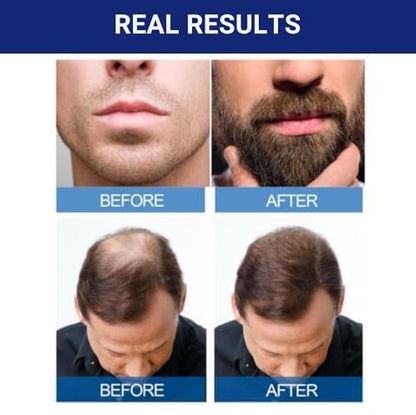 Kirkland Hair Max™ – Frena la caída, estimula el crecimiento y devuelve la densidad a tu cabello con Minoxidil 5% clínicamente comprobado 🧬✨